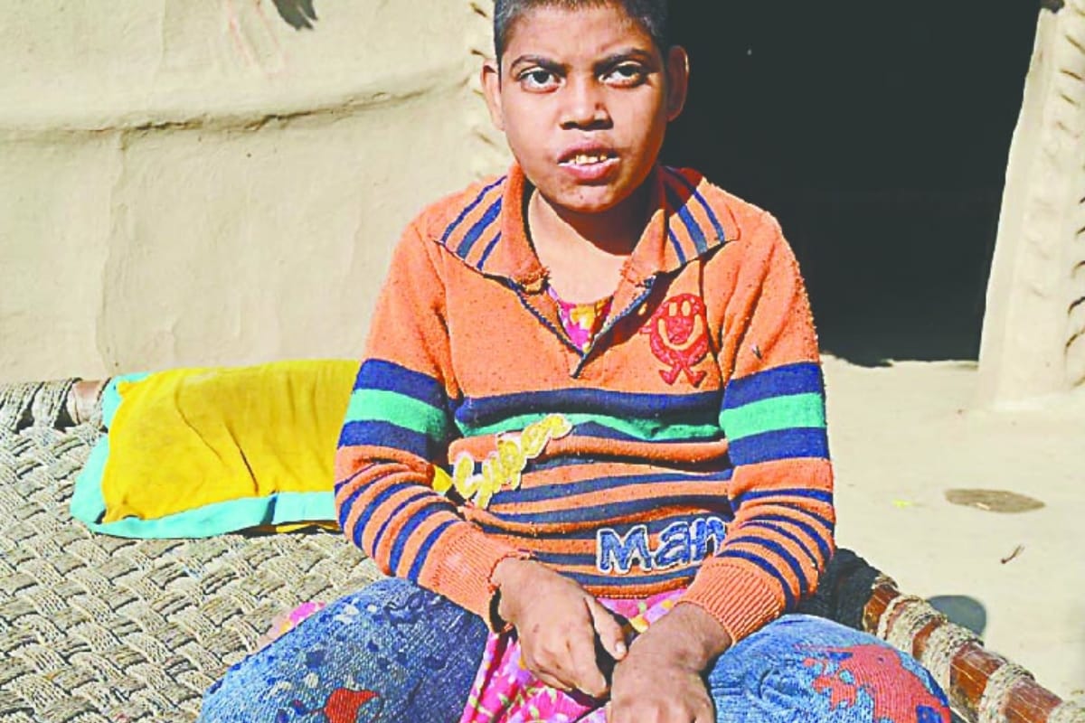 Life of children suffering from malnutrition becomes difficult