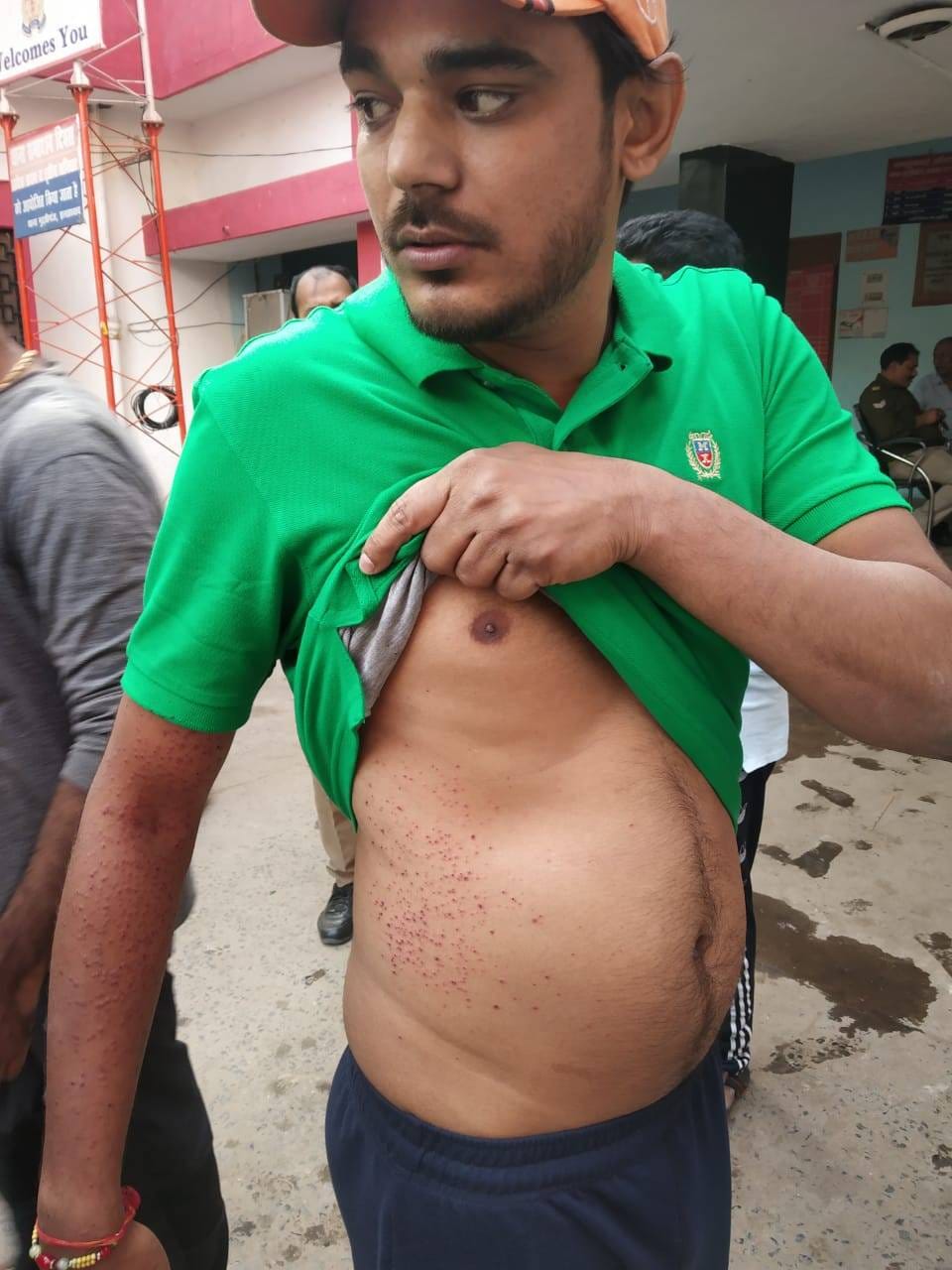 Fire in broad daylight on youth in anger, injured