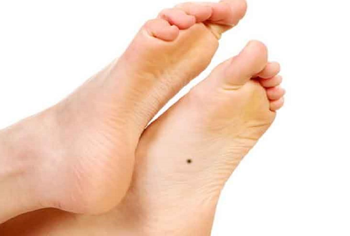 body mole meaning and importance