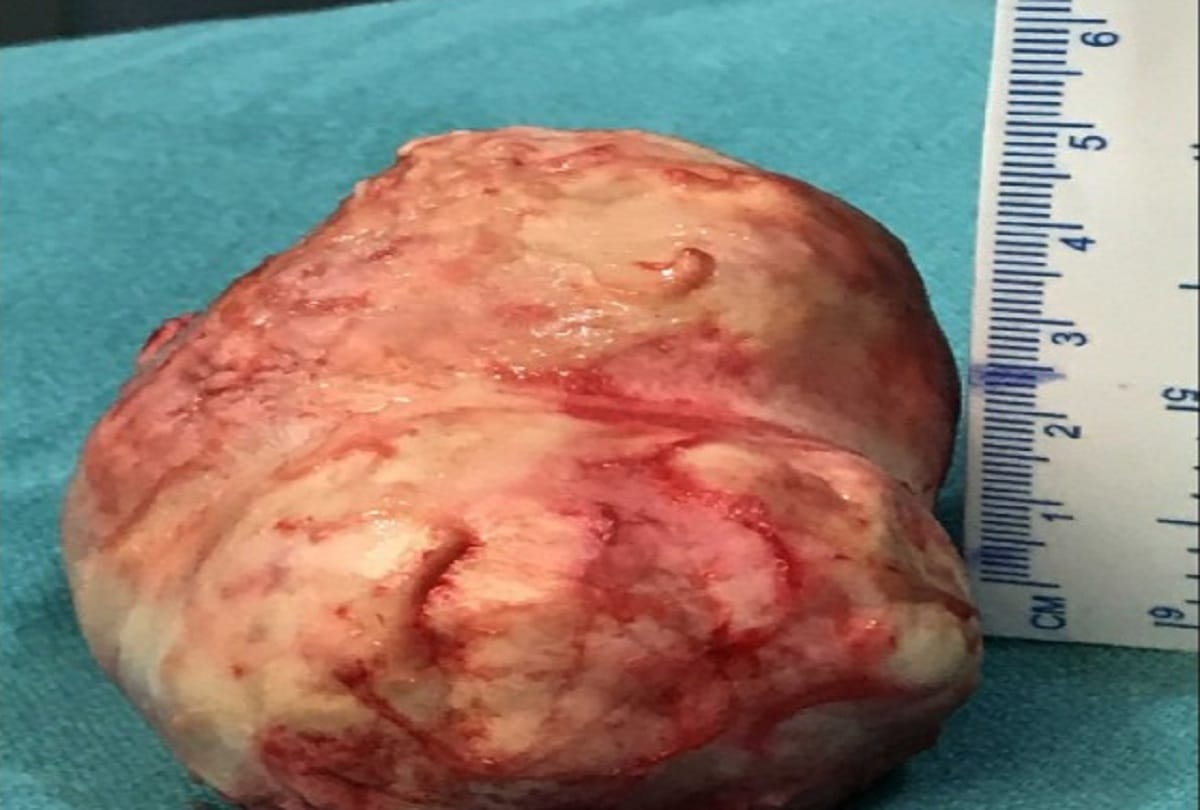 Doctors remove five kg tumor from women abdomen without operation