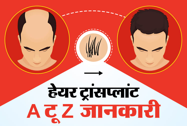Hair transplant cost, best hair transplant treatment, and side effects of hair transplant