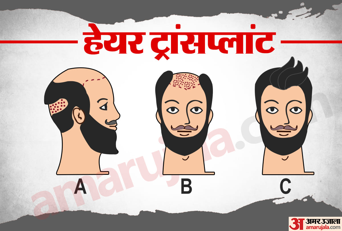 गंजेपन के प्रकार