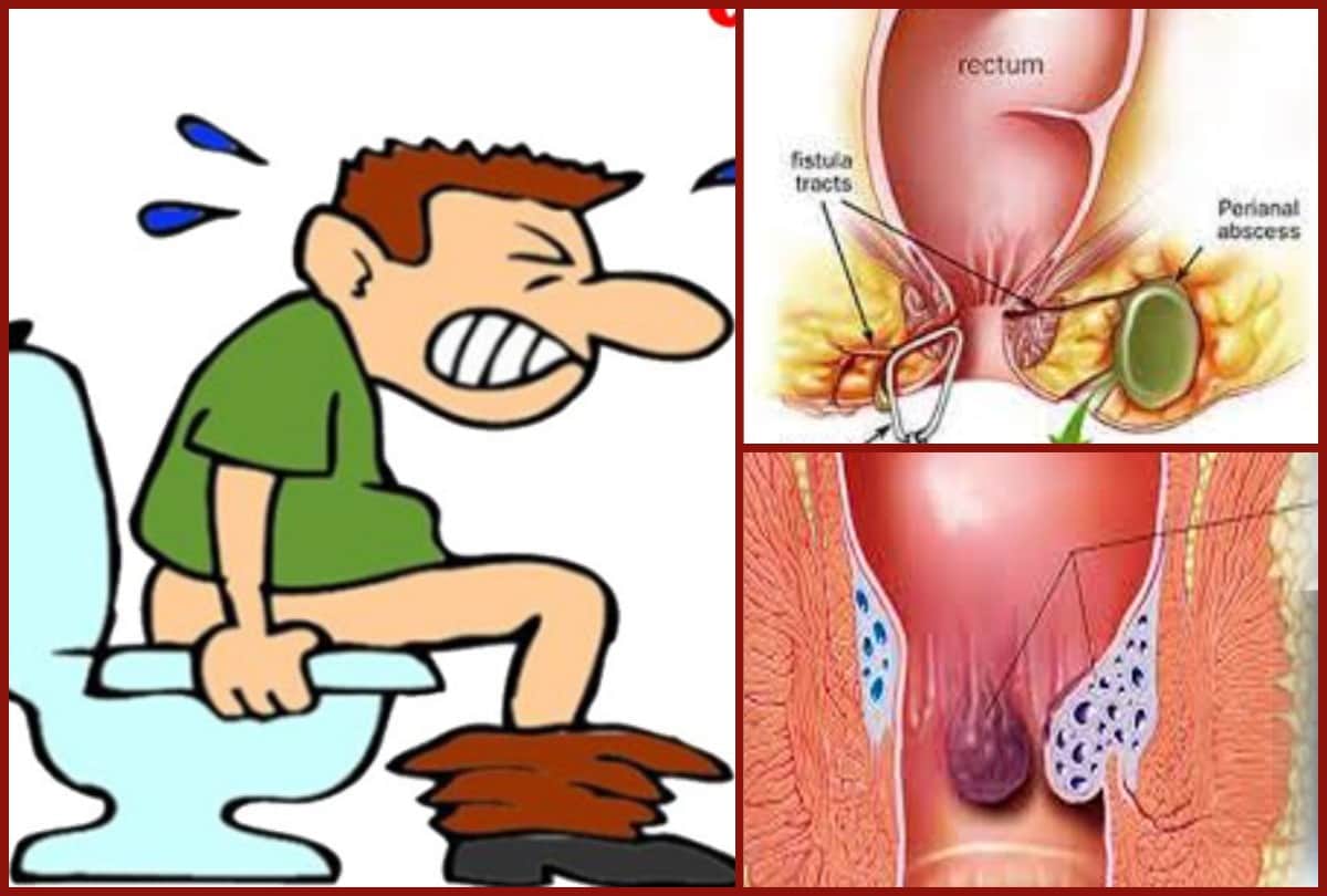 Fistula causes symptoms Prevention and treatment Surgery