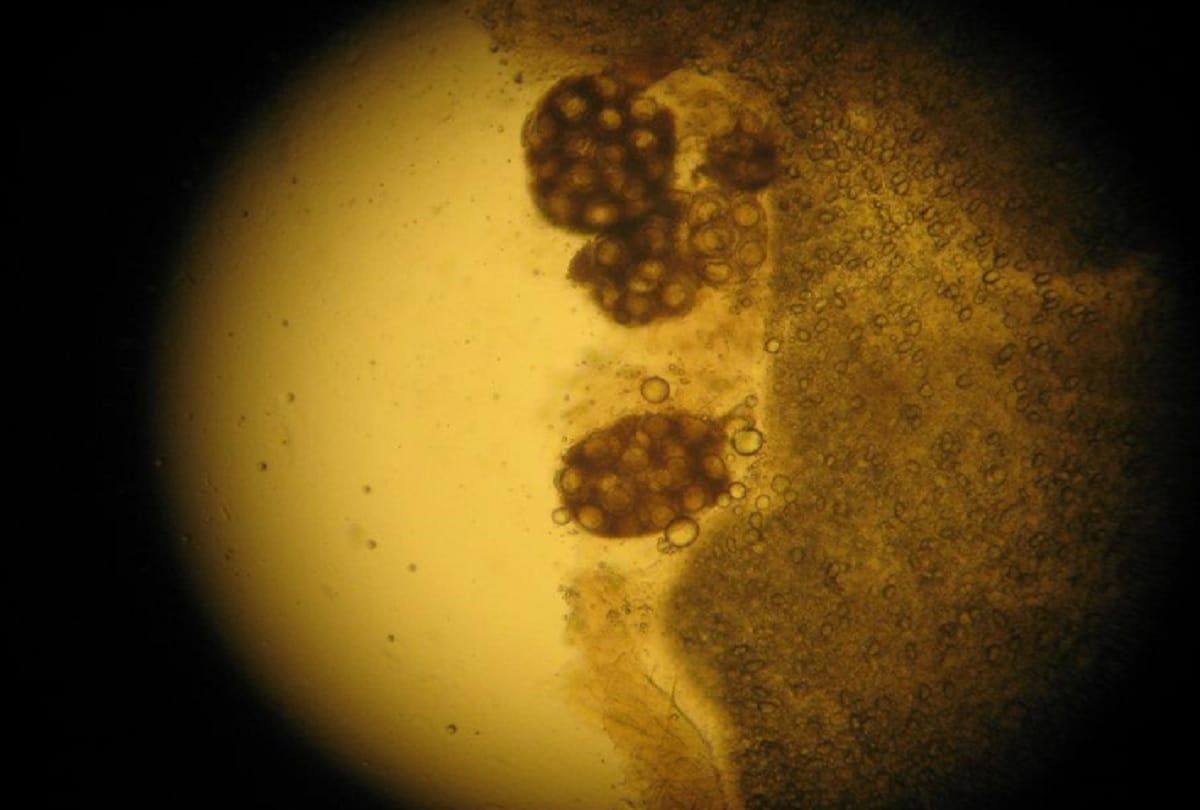 Doctors found more than 700 tapeworms in body of a man in china