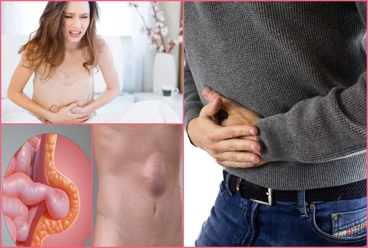 Hernia treatment causes symptoms risk factors home remedies