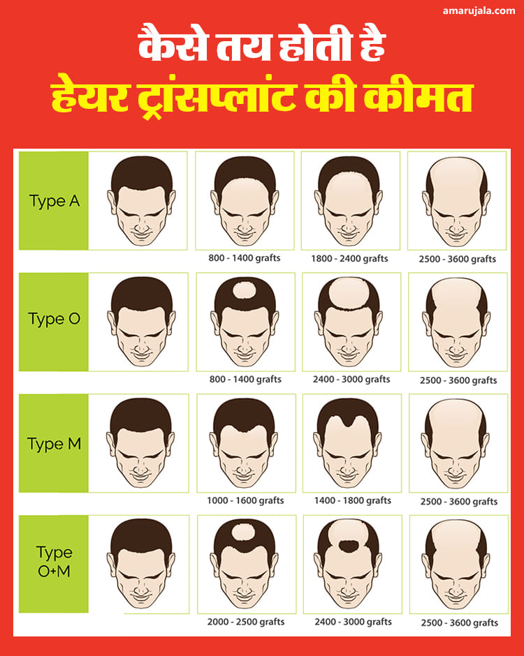 हेयर ट्रांसप्लांट की कीमत इन बातों पर निर्भर करती है