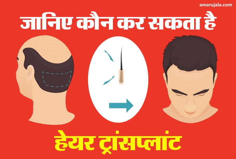 जानिए कौन कर सकता है हेयर ट्रांसप्लांट