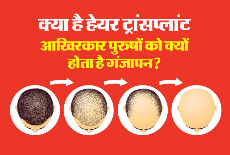 आखिरकार पुरुषों को क्यों होता है गंजापन?