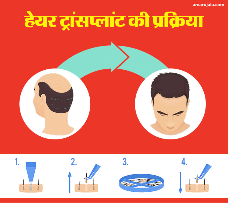 हेयर ट्रांसप्लांट की प्रक्रिया