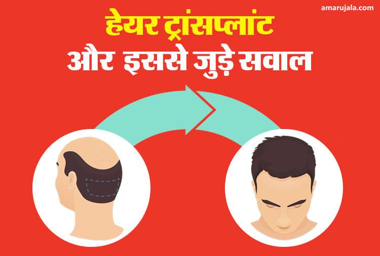 हेयर ट्रांसप्लांट और इससे जुड़े सवाल