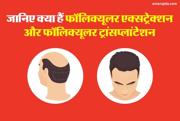 हेयर ट्रांसप्लांट दो तरीके से होता है: