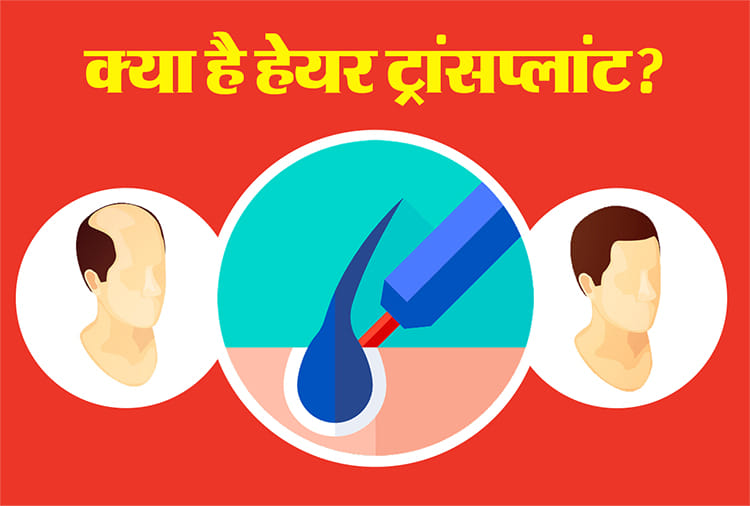 हेयर ट्रांसप्लांट