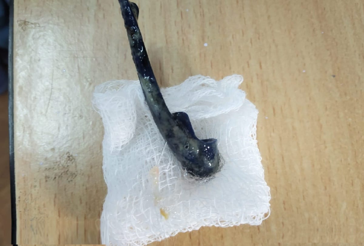 After 13 years, the pen's lid removed from the patient's lungs, the doctors got such success