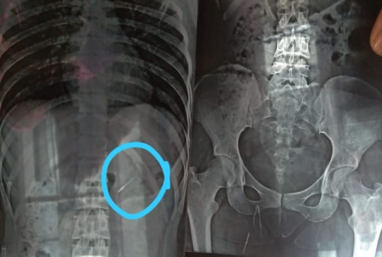 Needle into woman's stomach during tooth treatment