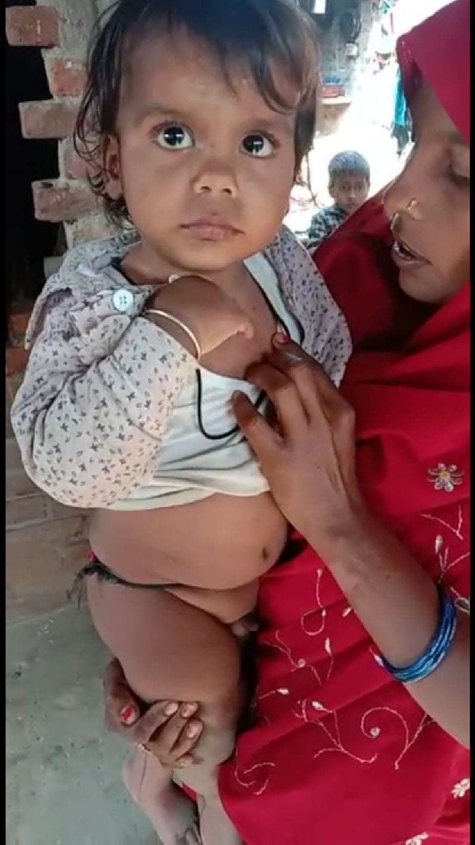 Measles spread in Sohriya, six people of the same family sick