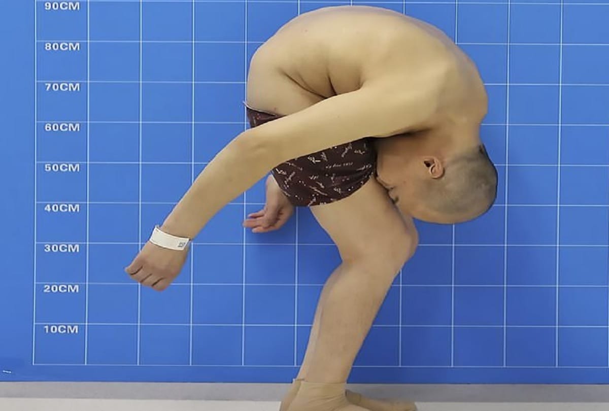China Folding man can finally stand straight after life changing surgery