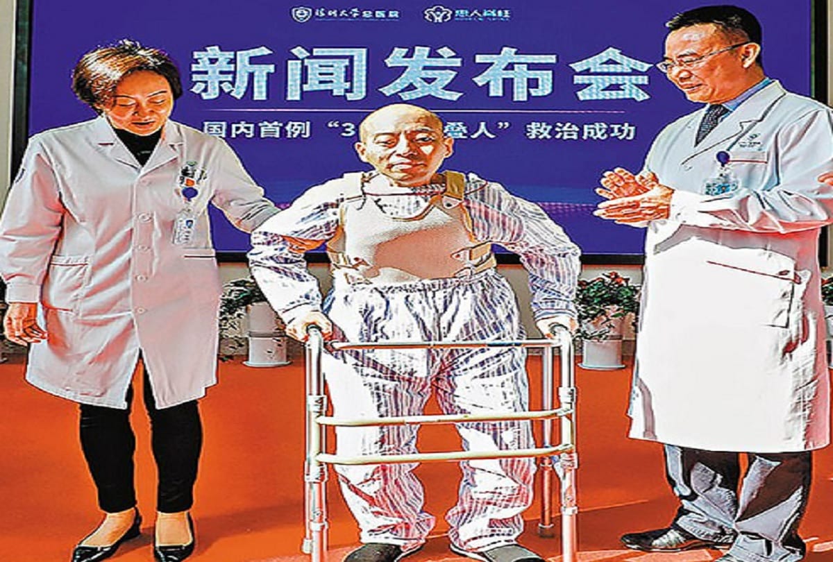 China Folding man can finally stand straight after life changing surgery
