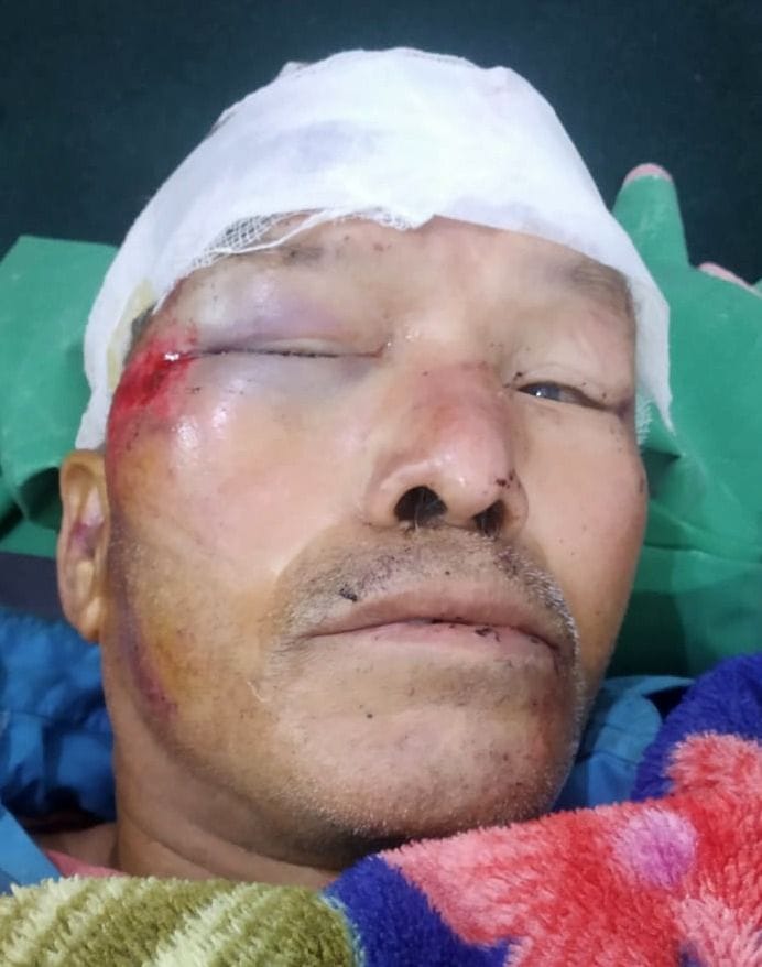 Villagers injured due to rock fall from hill