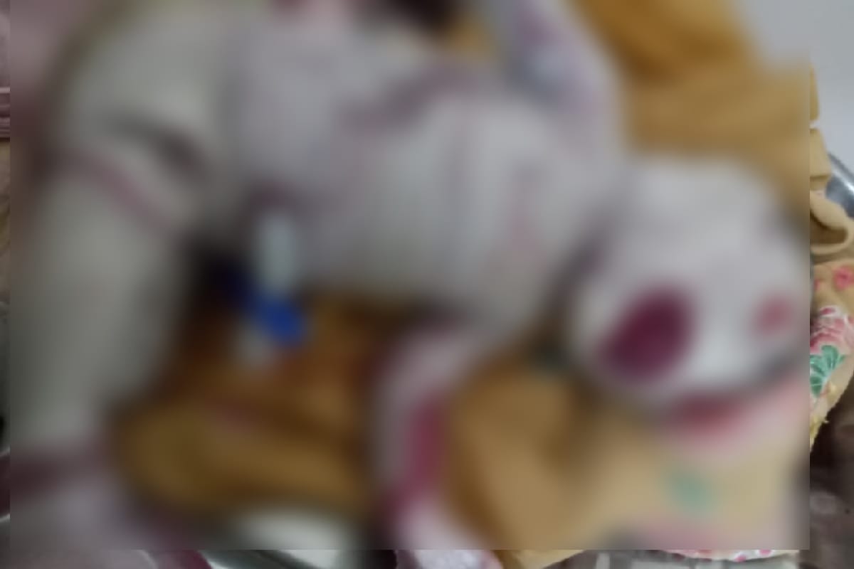 Harlequin baby born to Meerut woman, Harlequin Ichthyosis a rare genetic skin disorder