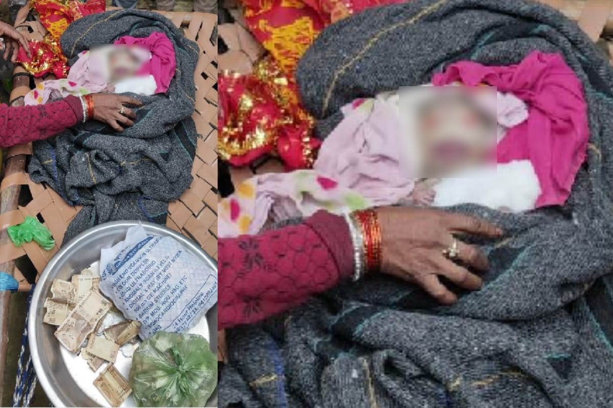 Harlequin baby born to Meerut woman, Harlequin Ichthyosis a rare genetic skin disorder