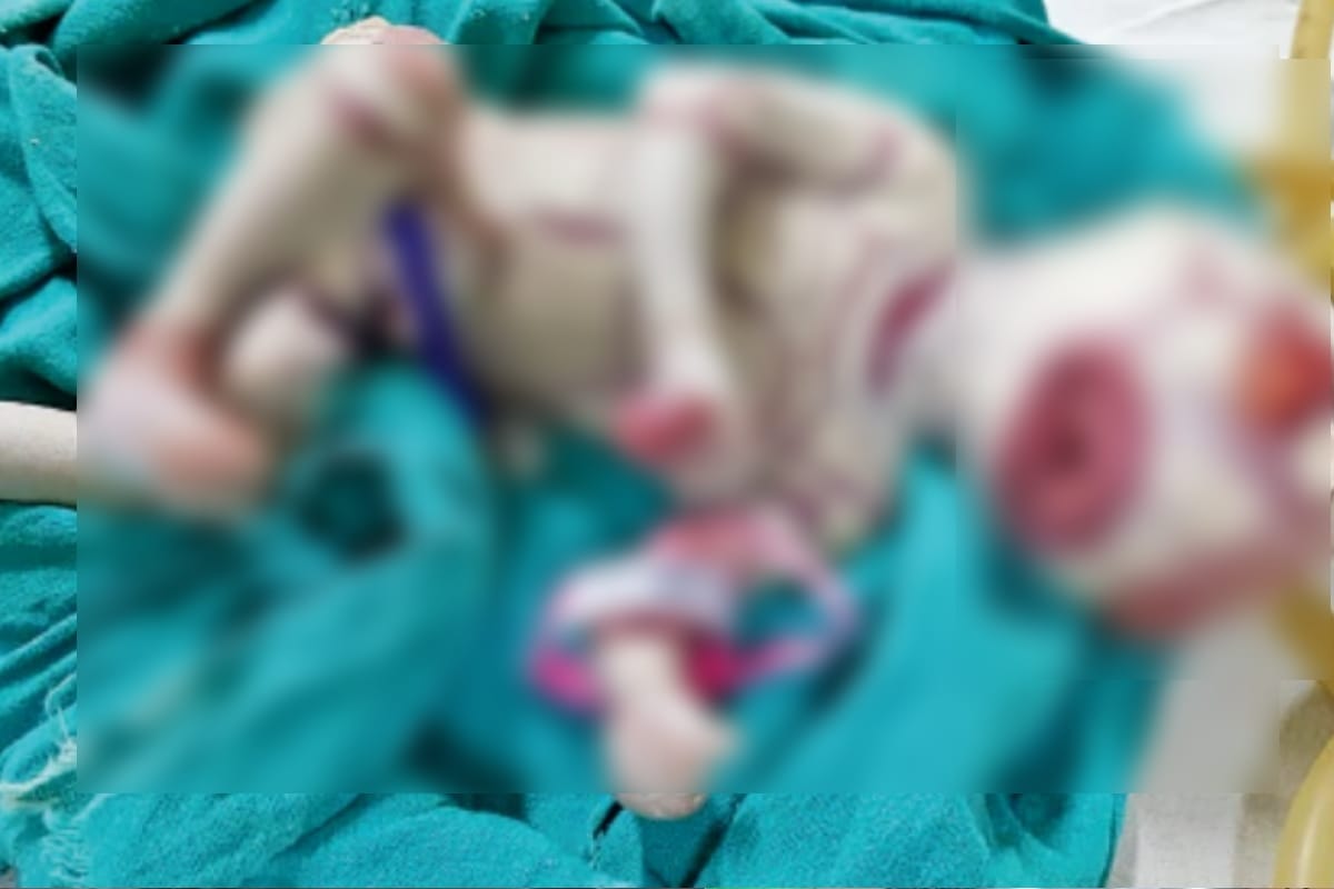 Harlequin baby born to Meerut woman, Harlequin Ichthyosis a rare genetic skin disorder