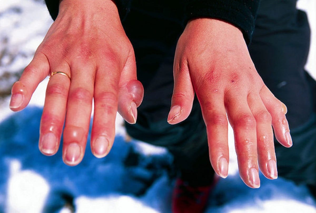 risk of hypothermia increased when temperature drops rapidly, prevent like this