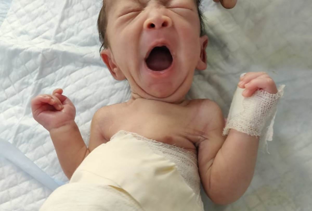 Iraq first baby in the world which born with 3 penises