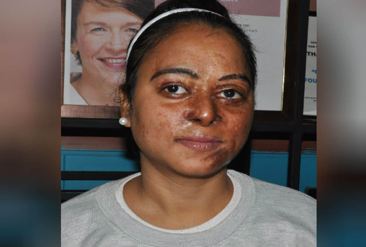 Real Story Of Acid Attack Brave Girls Chhapaak Film