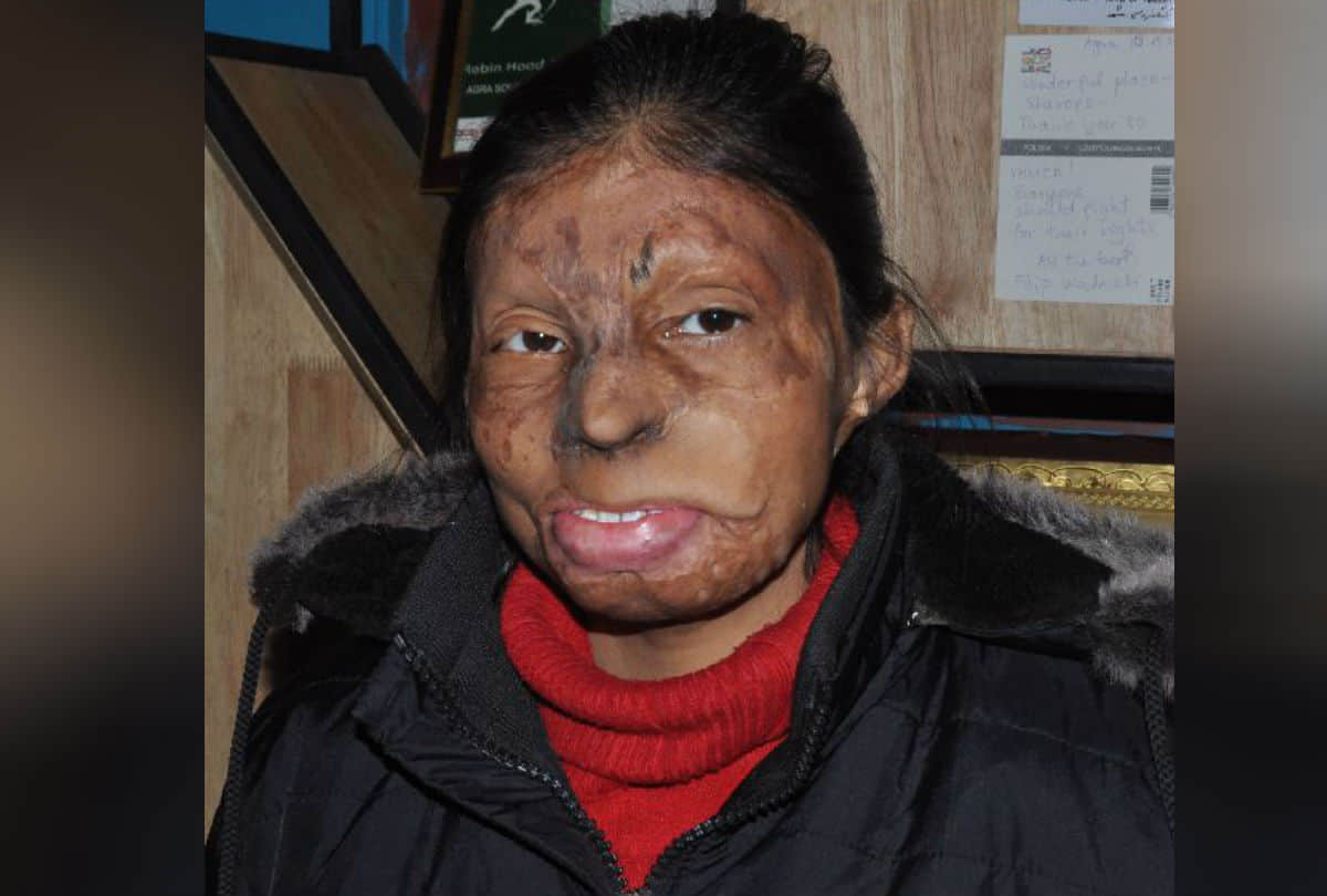 Real Story Of Acid Attack Brave Girls Chhapaak Film