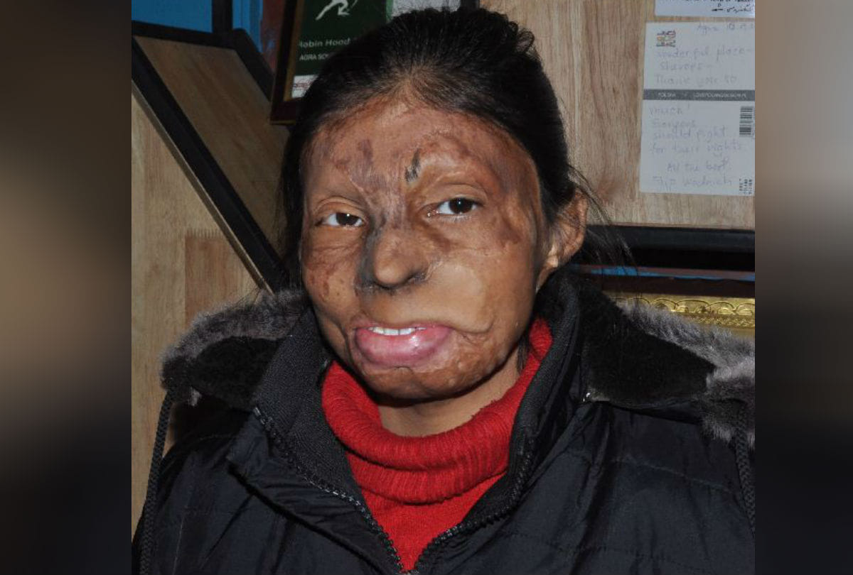 Real Story Of Acid Attack Brave Girls Chhapaak Film