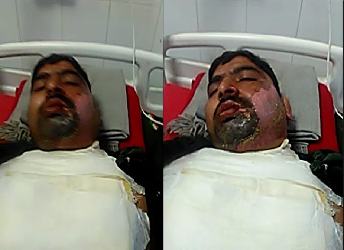 CRPF DIG injured CRPF jawan face from hot water in 64 battalion rajgir