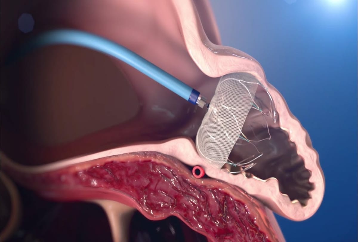 This device prevents from blood clotting, can protect from heart stroke