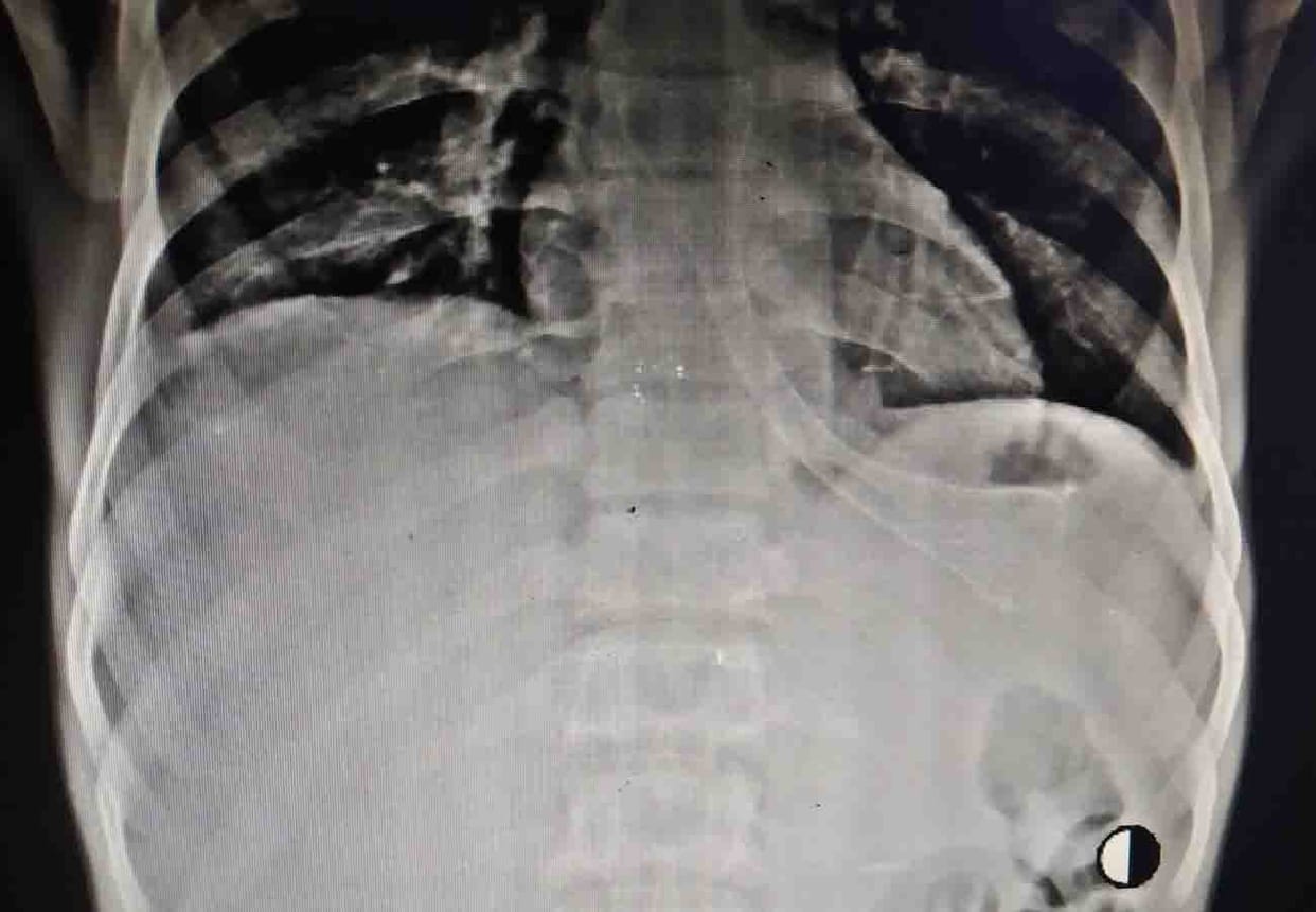 Stenting therapeutic procedure used for the first time in hallet Kanpur