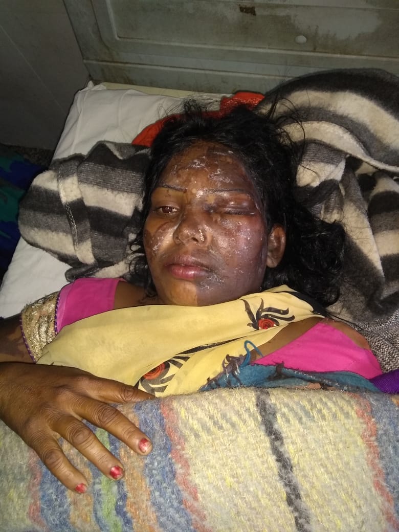 acid attack to own wife and run away at gorakhpur