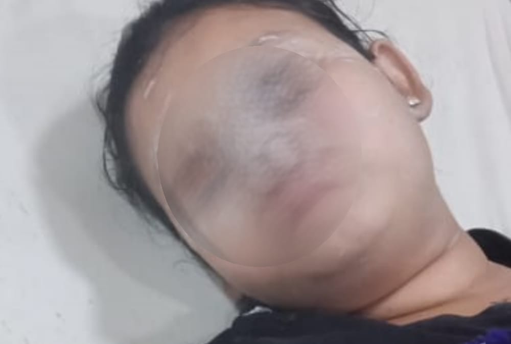 Acid thrown on a girl in Kaiserbagh in Lucknow.