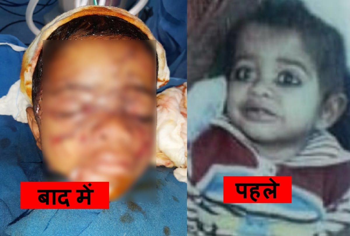 faridabad four year old boy bitten by atleast five dogs, 200 stiches one eye badly injure