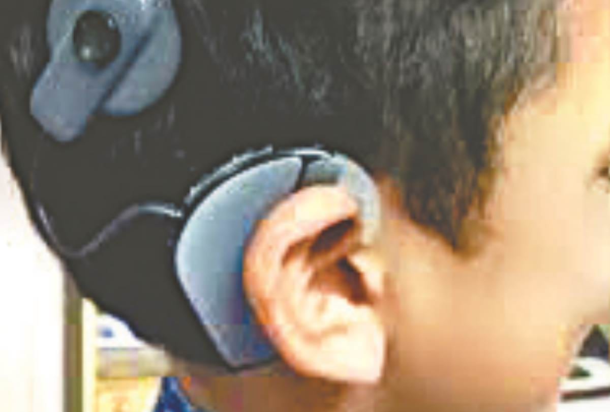 know about the cochlear implant