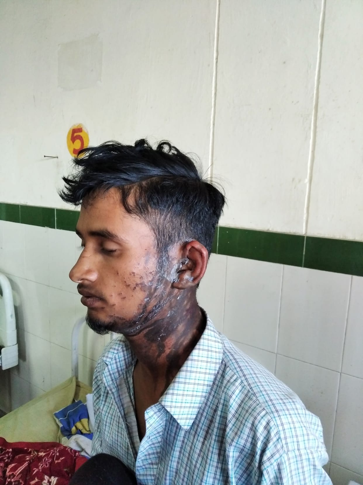 Acid attack on young man in Rankhila village