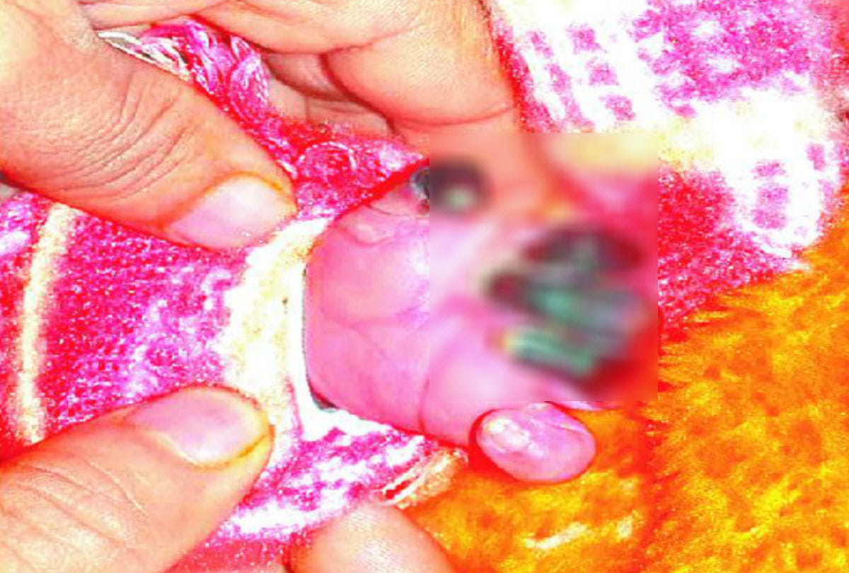 spread infection in hand of newborn due to doctors negligence in agra