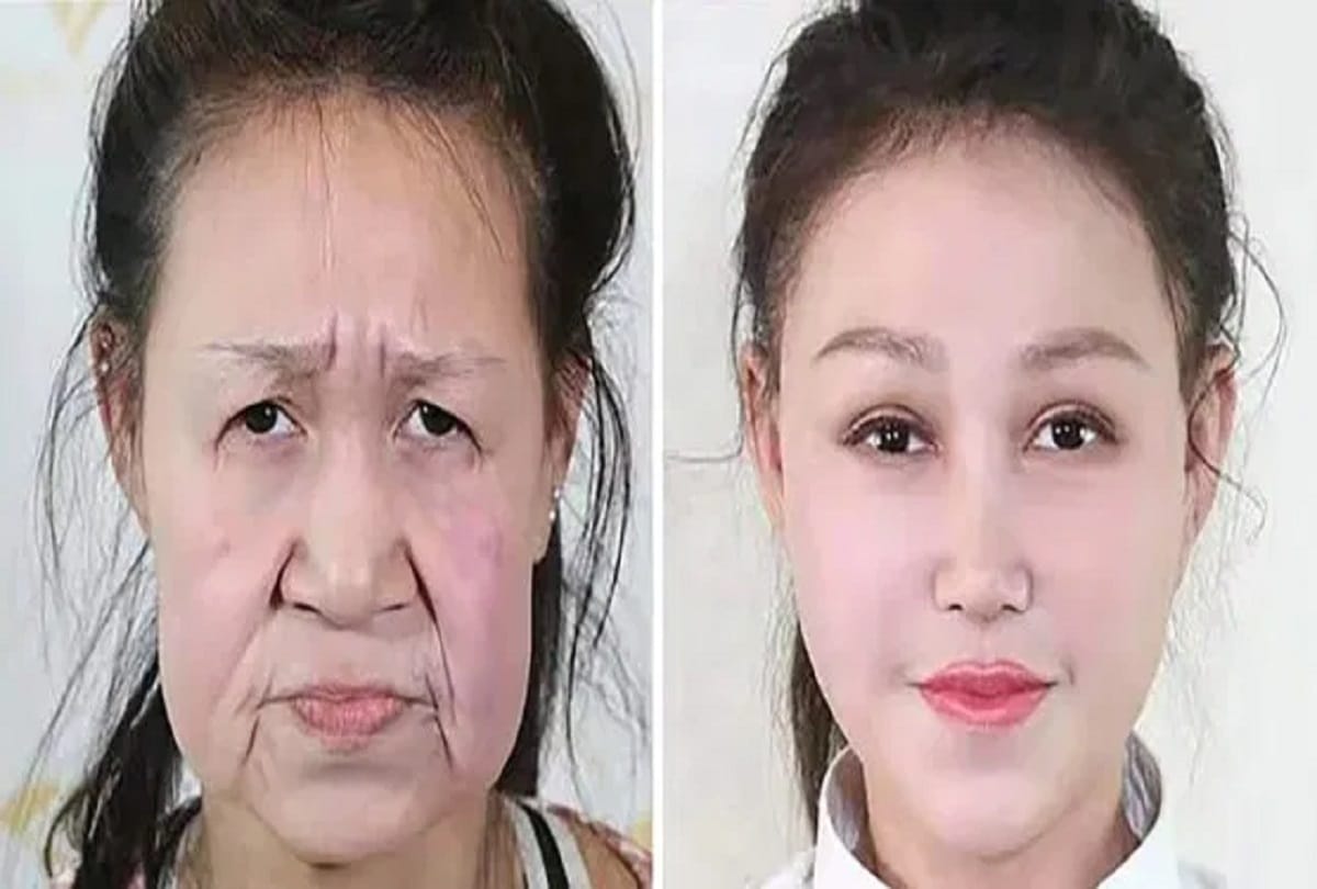 15 years old Girl looked like she was 60 surgery gives her a new face