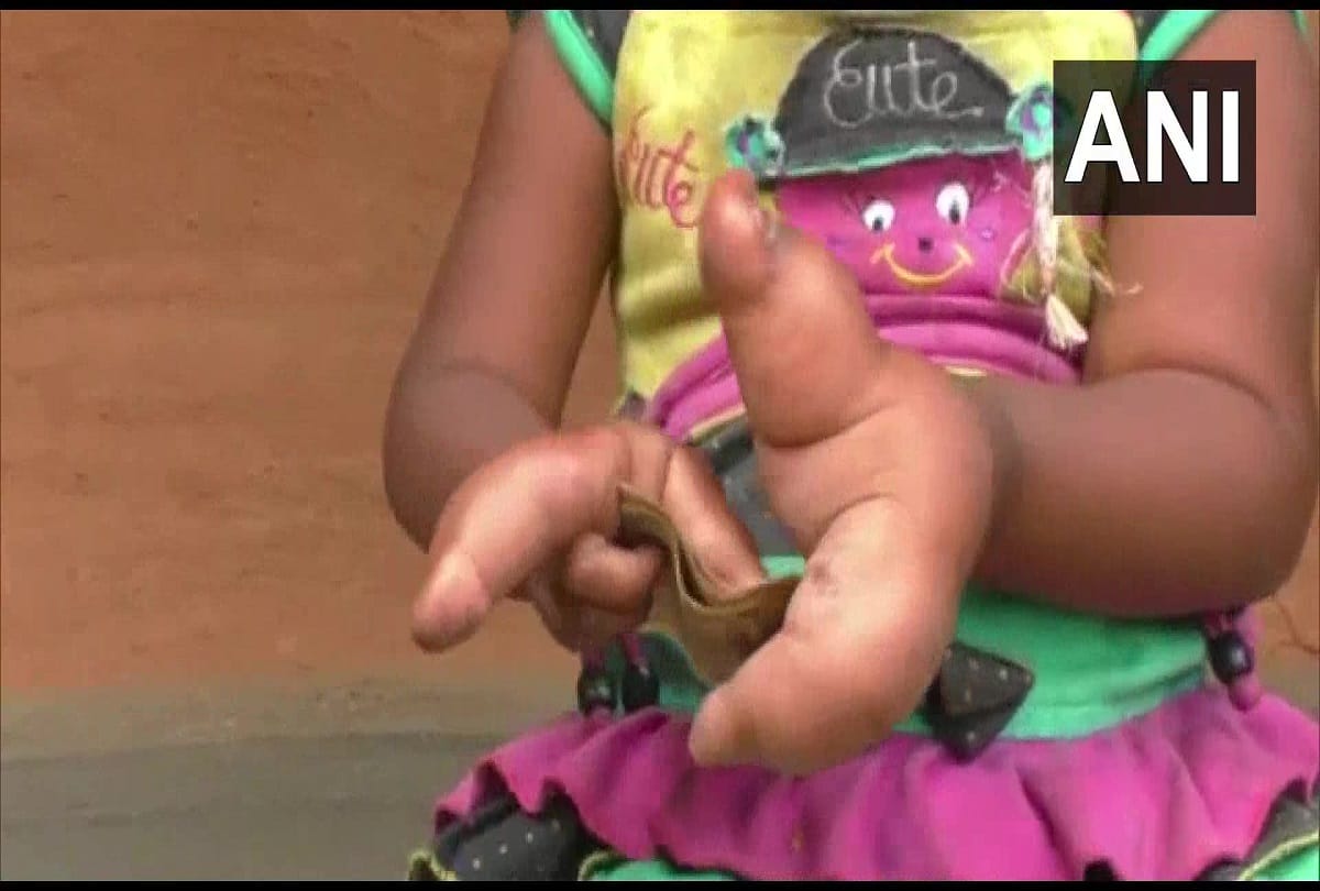 Three year old girl in Odisha fingers constantly growing, family hope of help from government