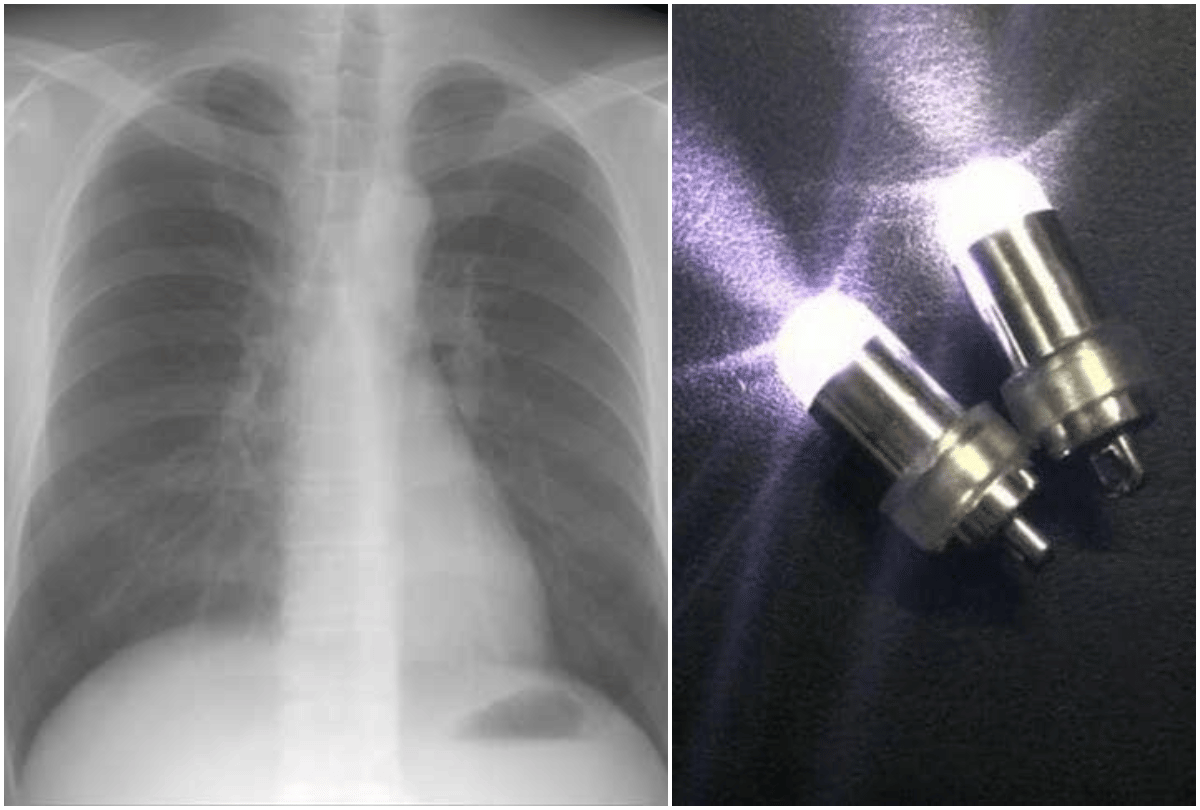 doctor surprised by xray child swallows led bulb
