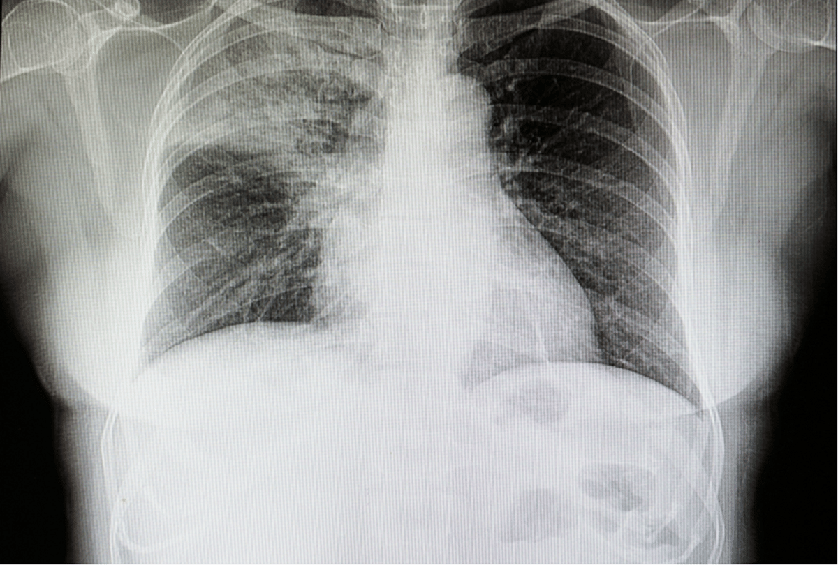 doctor surprised by xray child swallows led bulb