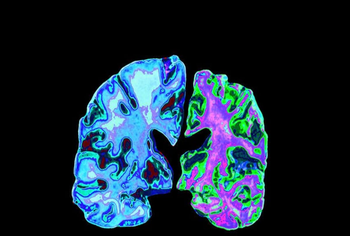 Identified genetic changes that reduce the risk of Alzheimer
