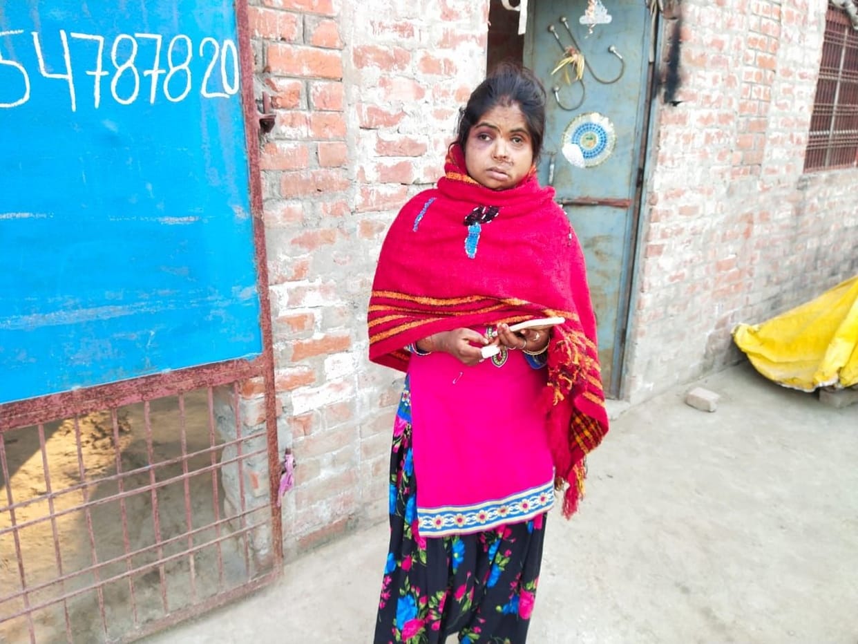 Pratapgarh: acid thrown in unrequited love, marriage of a bully, now becomes an enemy of life
