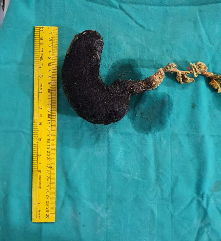 Bunch of 2 kg hair removed from stomach