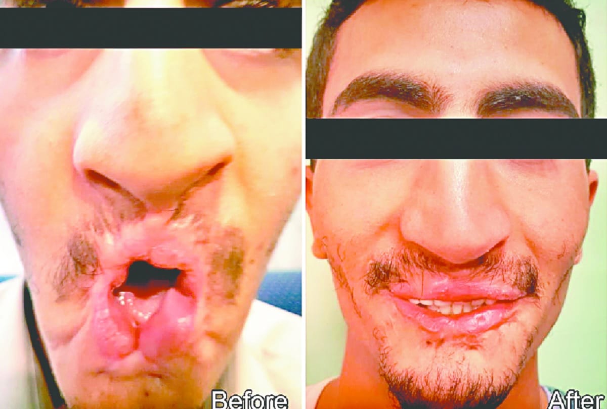 26 year old man of Yemen gets new life, rare surgery of mouth mutilated by mobile burst