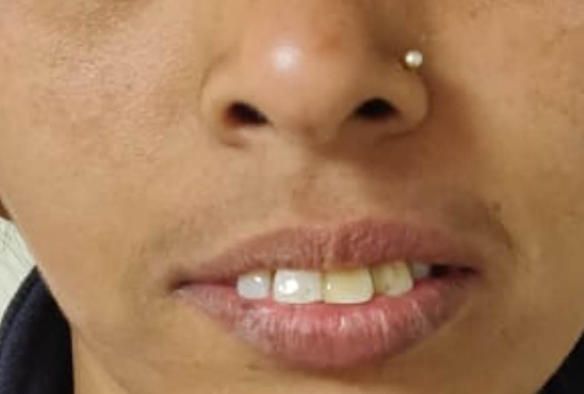 new experiment started for bone of jaw in KGMU