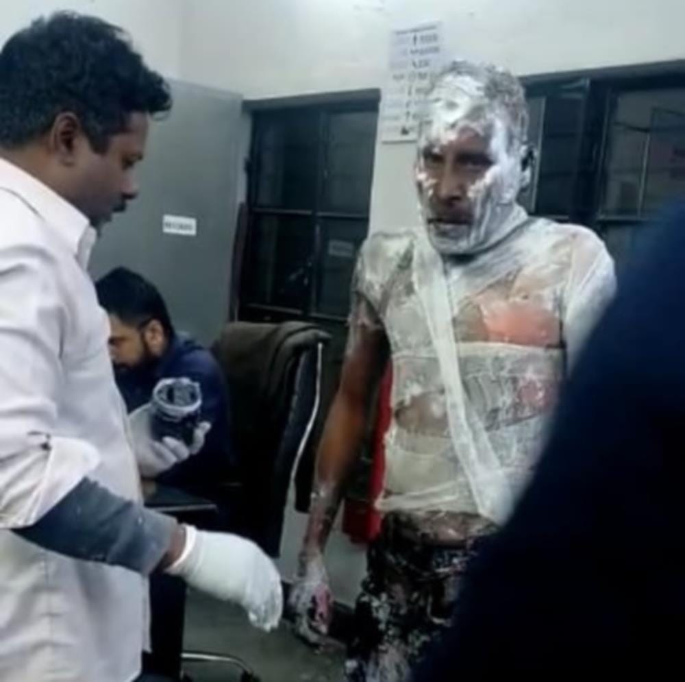 Roorkee: man returning home burnt under suspicious circumstances