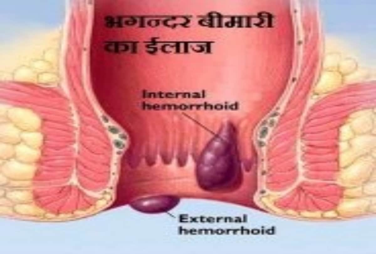 Fistula causes symptoms Prevention and treatment Surgery